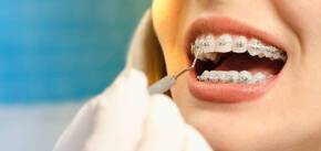 Порівняння ортодонтичного лікування: елайнери проти брекетів