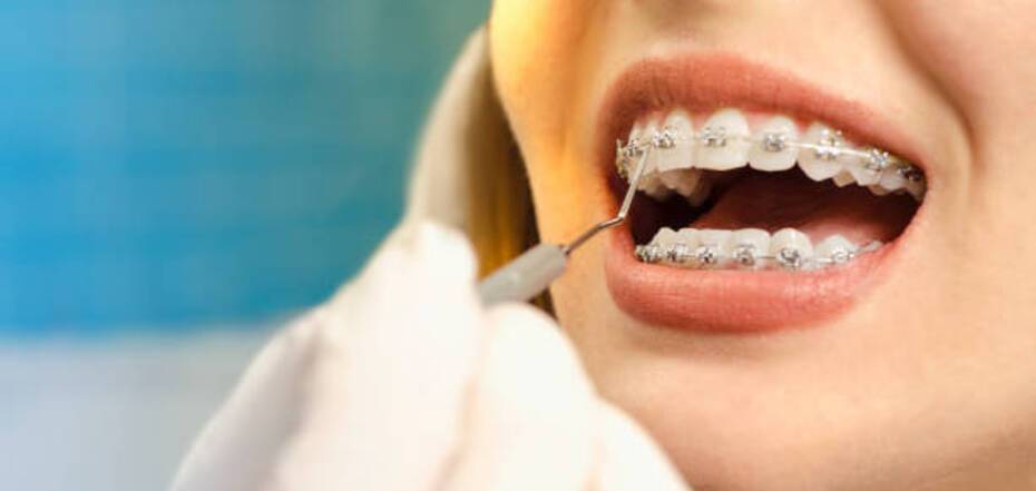 Сравнение ортодонтического лечения: элайнеры против брекетов